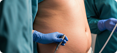 Endoscopic Sleeve Gastroplasty