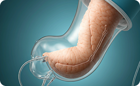 Roux-en-Y Gastric Bypass